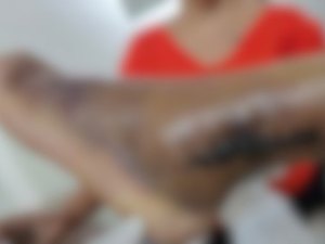 Família acusa plano de saúde de série de negligências que provocaram risco de amputação em pé de idosa