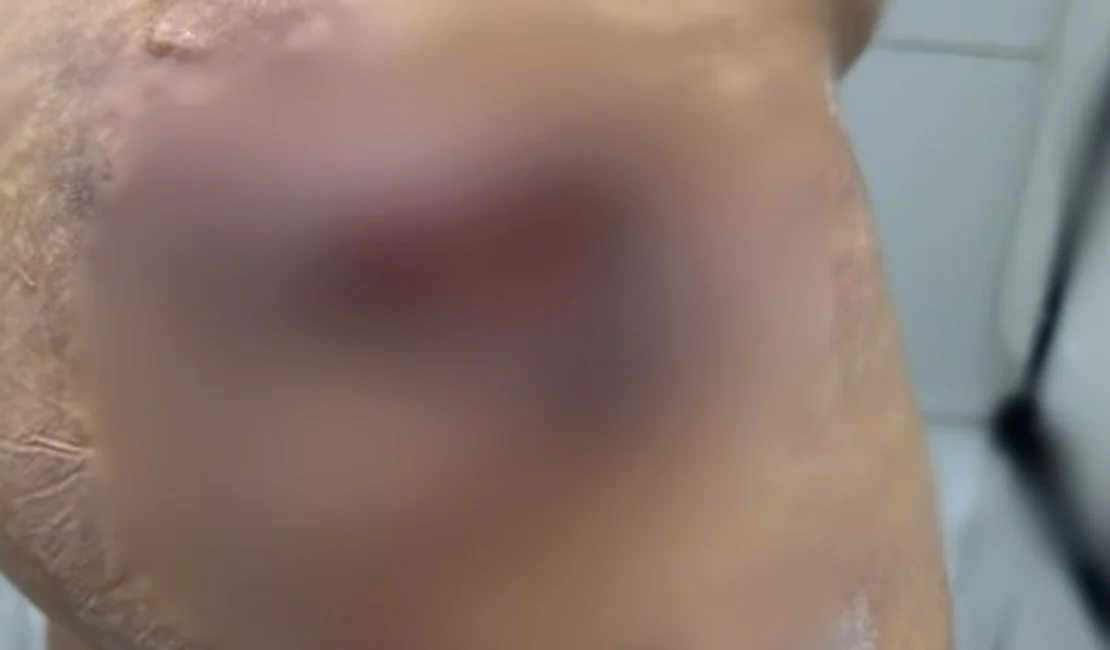 Dentista de Arapiraca é investigada por usar silicone industrial e necrosar glúteos de pacientes