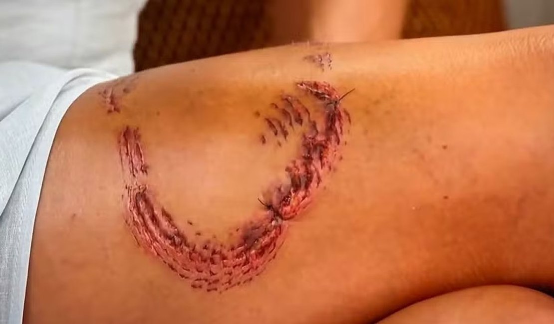 Turista mostra perna com marcas de mordida de tubarão em Noronha e fala sobre dor