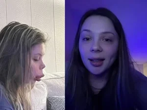 Mulher faz preenchimento labial “barato” e resultado é desastroso