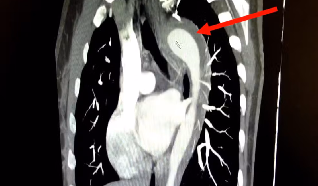 Em caso raro, mulher de 45 anos rompe aorta após orgasmo; entenda a condição