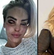 Atacada com ácido, apresentadora britânica já fez 400 cirurgias