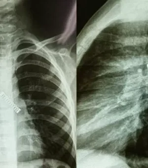 Menino sofre de tosse constante e médicos acham mola de metal no pulmão