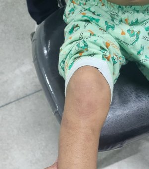 Trauma e hematomas: menino vítima de maus-tratos em Maceió é entregue ao pai