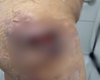 Dentista de Arapiraca é investigada por usar silicone industrial e necrosar glúteos de pacientes