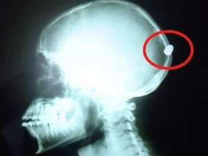 Adolescente leva dois meses para descobrir tiro na cabeça em SP