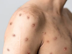 Mpox chega a 81 casos no Brasil em 2026; veja sintomas e quando suspeitar