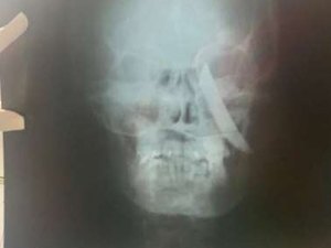 Mulher tem faca cravada no crânio por ex e sobrevive