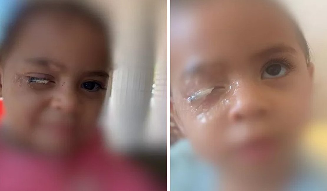 Menina de 2 anos vai parar no hospital após grudar olho com cola, no DF
