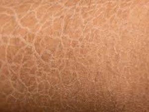 Com doença rara na pele, criança de Girau do Ponciano é barrada em voo para São Paulo