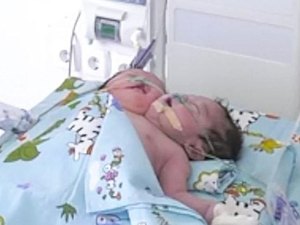 Mãe tem bebê de duas cabeças e é forçada a entregá-lo para adoção