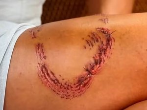 Turista mostra perna com marcas de mordida de tubarão em Noronha e fala sobre dor