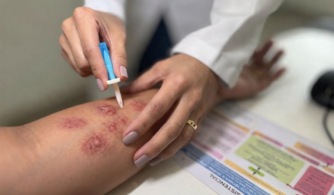 Hospital Ib Gatto Falcão contribui para a detecção precoce e orientação no enfrentamento à hanseníase