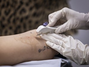 Em dois meses, Implanon é disponibilizado para mais de 600 mulheres