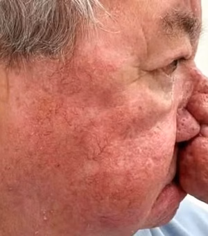 Escocês com nariz gigantesco se submete a cirurgia para poder voltar a beijar a esposa