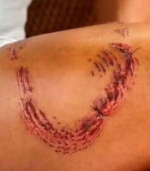 Turista mostra perna com marcas de mordida de tubarão em Noronha e fala sobre dor
