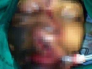 Celular explode enquanto carregava e usuário teve fratura no rosto e queimaduras no corpo