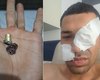 Homem sobrevive a tentativa de homicídio após ser baleado na AL-115, em Arapiraca