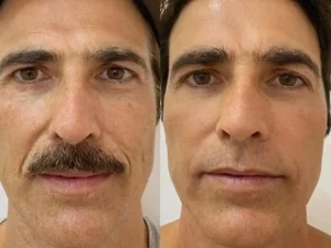 Reynaldo Gianecchini faz rejuvenescimento facial e mostra resultado na web