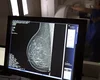 Ministério da Saúde passa a recomendar mamografia a partir dos 40 anos
