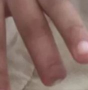 Criança tem dedo cortado por professora após desobediência em sala de aula