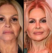 Antes de se casar, Monique Evans faz harmonização facial e mostra resultado