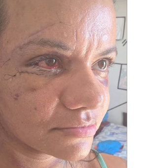 Mulher espancada com mais de 60 socos mostra rosto após cirurgia para reconstrução facial