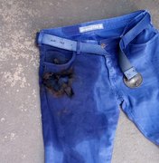 Enfermeiro tem queimadura na perna após celular explodir no bolso da calça