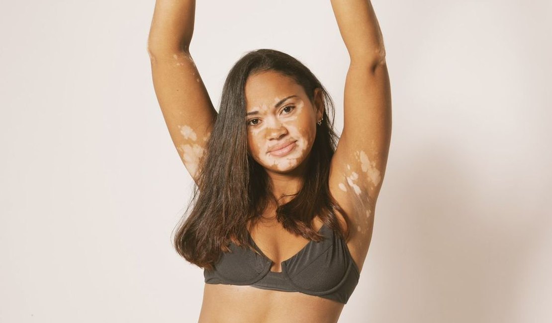 Mulheres com Vitiligo e PcD quebram barreiras e conquistam sua liberdade ao se tornarem modelos de moda praia