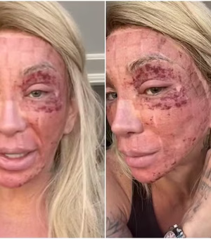 Inflamação no rosto de Maya Massafera aumenta após procedimento