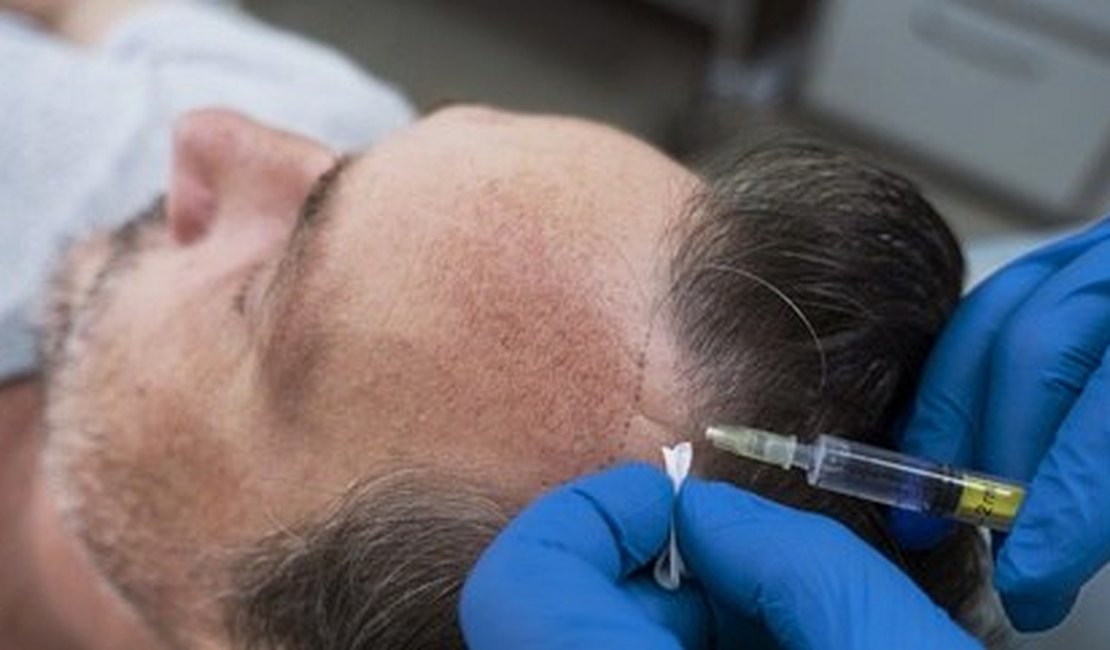 Gasto com transplante e implante de cabelo sobe 60% em um ano