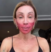Com o rosto vermelho após novo peeling, Maya Massafera rebate críticas