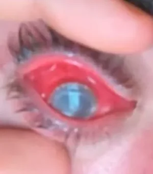 Homem tem olho devorado por parasita após dormir com lentes de contato