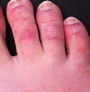Novo Sintoma: 'Dedos de covid' podem durar até 150 dias em pacientes, mostra estudo