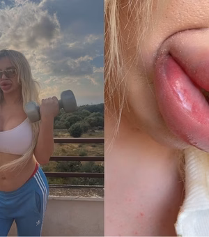 Influencer não consegue mais fechar a boca após preenchimentos labiais