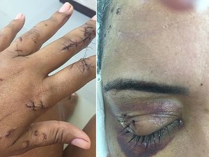 Fisioterapeuta leva 69 facas de ex-namorado e sobrevive 