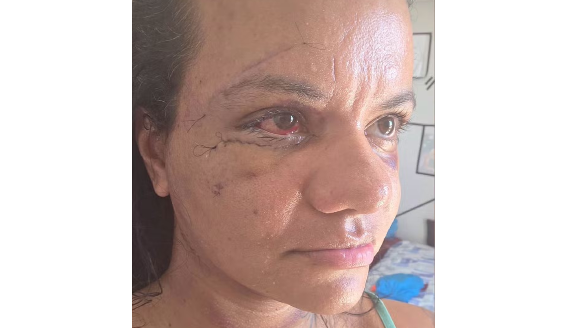 Mulher espancada com mais de 60 socos mostra rosto após cirurgia para reconstrução facial