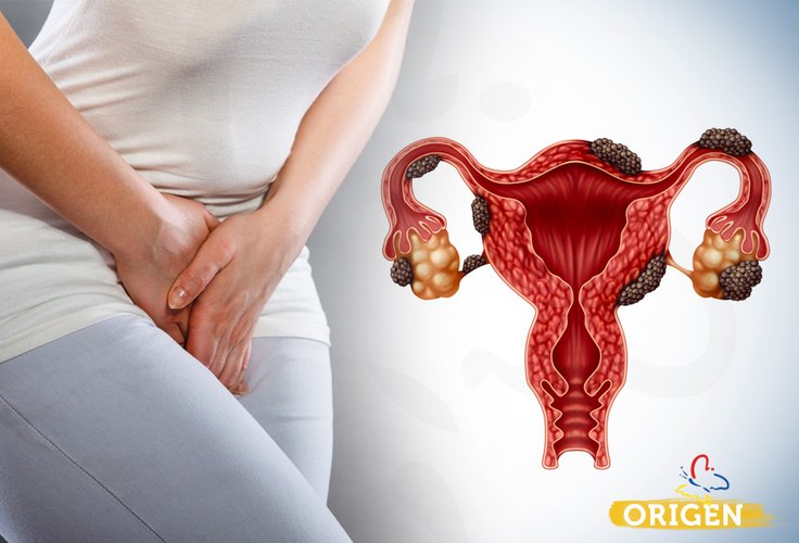 Endometriose: um alerta para o coração da mulher