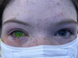Doença que deixa olho esverdeado e 'dói como parto' alerta australianos