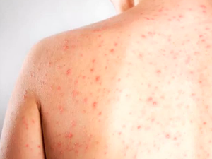 Estado do Rio registra primeira morte por sarampo