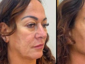 Mãe de Neymar realiza harmonização facial