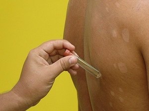 Saúde reforça cooperação técnica para frear casos de hanseníase em Rio Largo