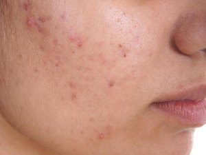 Pesquisadores estão desenvolvendo vacina contra acnes