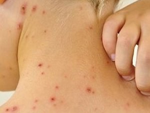 Aumenta o número de casos de catapora em Arapiraca