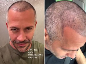 Malvino Salvador mostra a cabeça 10 dias após transplante capilar
