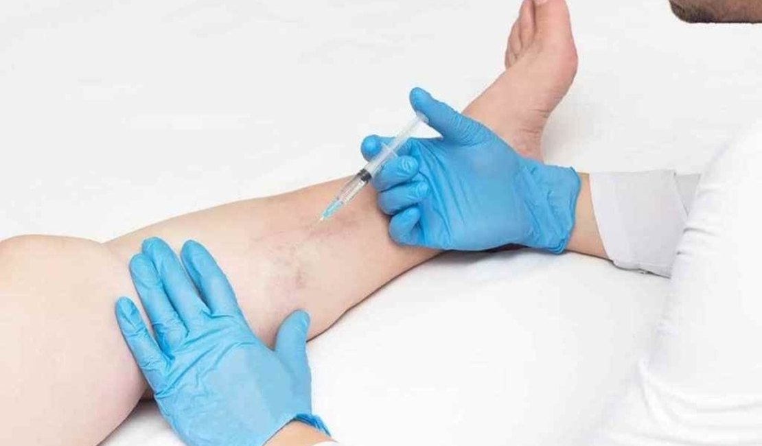 Saúde disponibiliza tratamento de microvasos e varizes no Pam Salgadinho