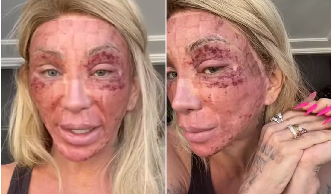 Inflamação no rosto de Maya Massafera aumenta após procedimento
