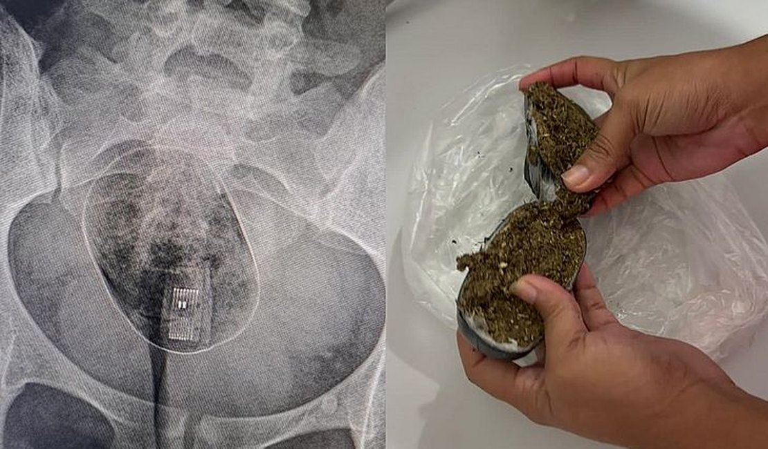 Mulher tenta entrar em presídio com drogas e pen drive nas partes íntimas e agora precisa cirurgia