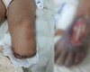 Idosa que corria risco de perder o pé após suposta negligência médica tem parte da perna amputada