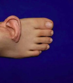 Médicos chineses enxertam orelha em pé de paciente